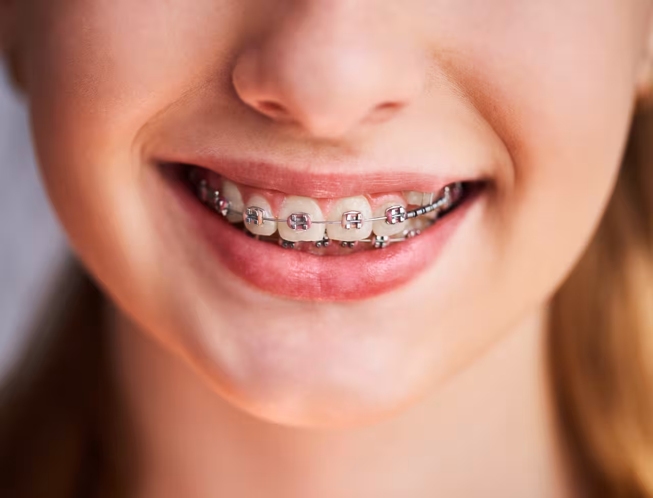 Braces