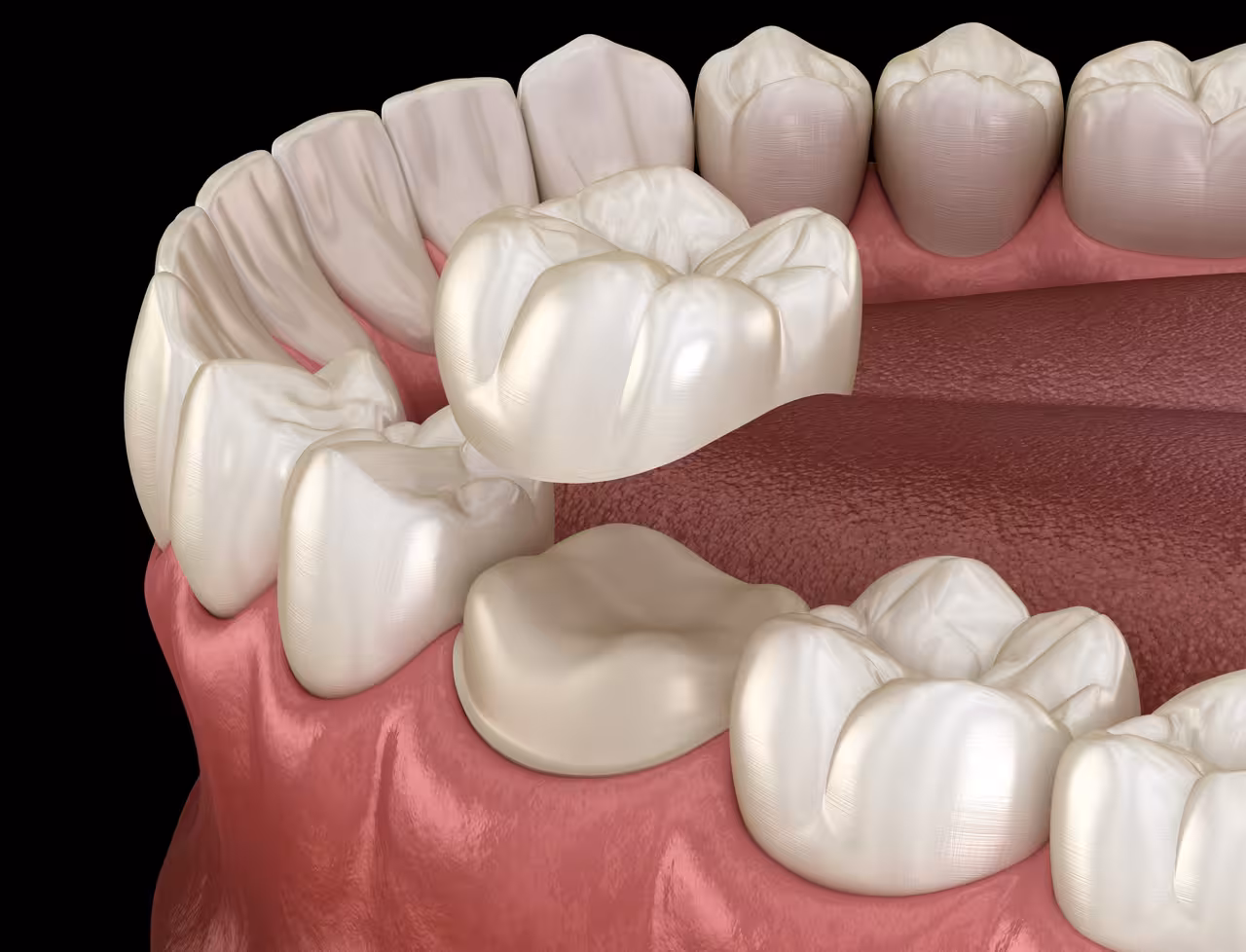 Same Day CEREC Dental Crowns