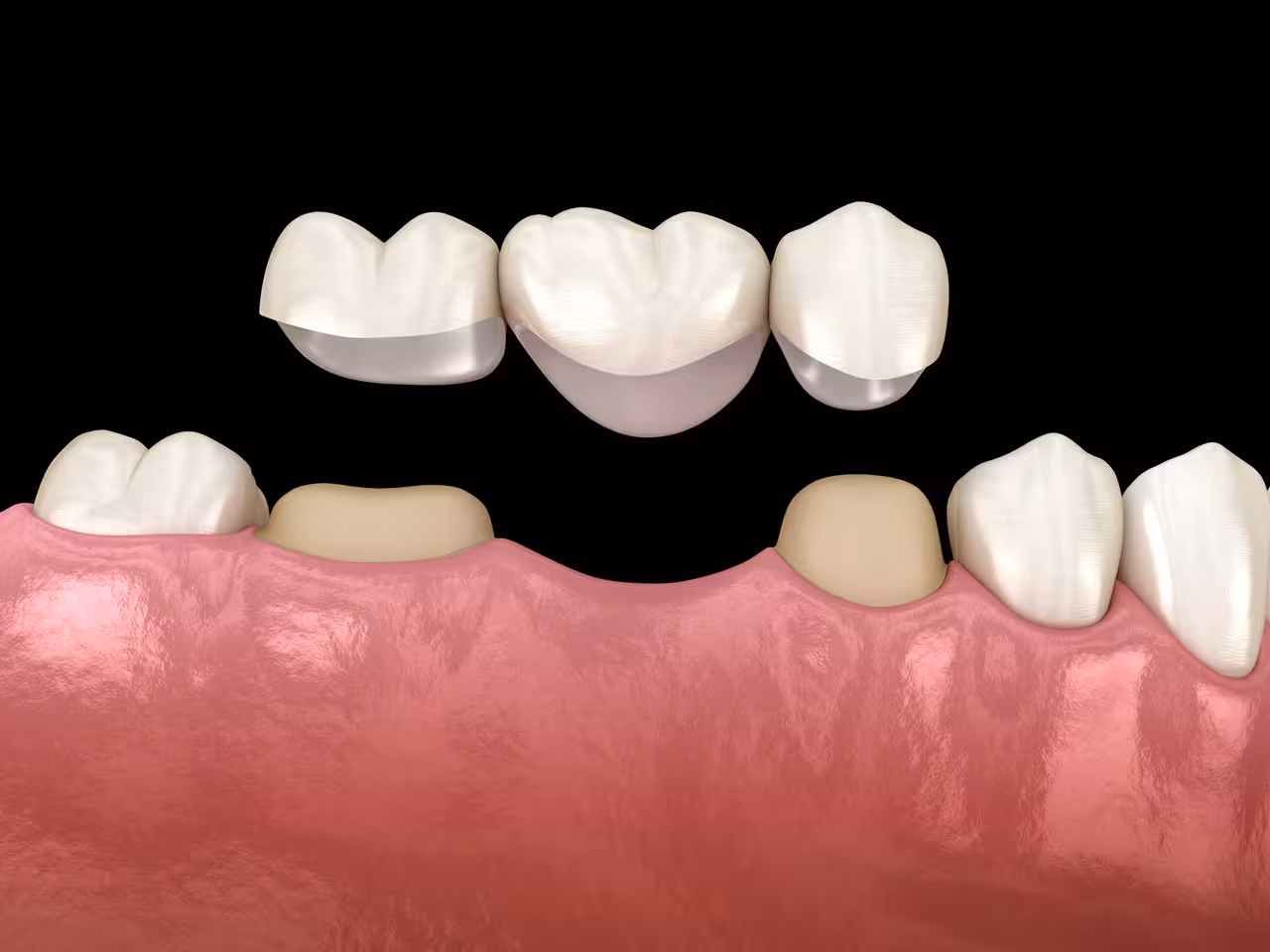 Dental Bridges